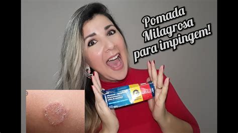Melhor Pomada para Impingem: Top 7 Tratamentos que Funcionam em 2024