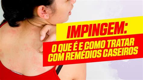 Como Tratar Impingem em Casa: 7 Remédios Caseiros que Funcionam